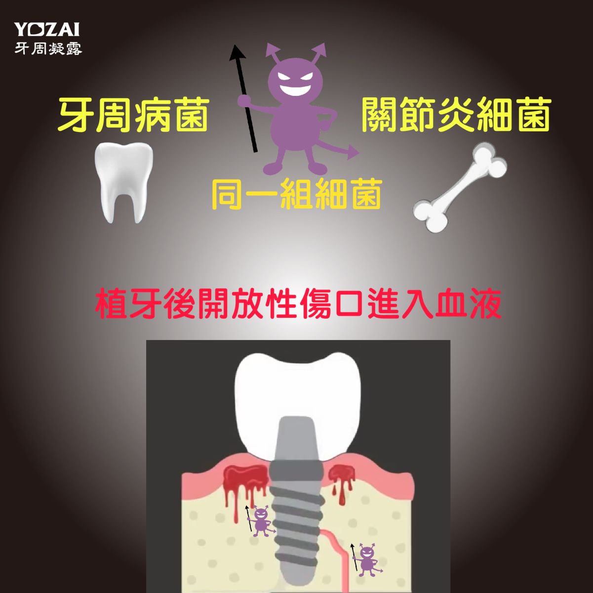 牙周病菌與關節炎細菌同組細菌