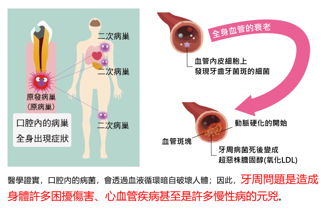 YOZAI-牙周病在日本被稱為病巢