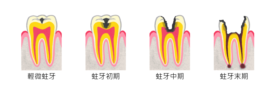 YOZAI-蛀牙過程